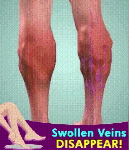 Furzero Bee Venom Varicose Veins Spray  BUY 1 GET 2 FREE 